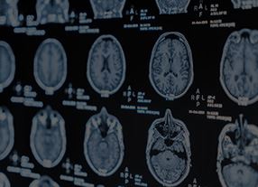 Traumatic Brain Injury Image